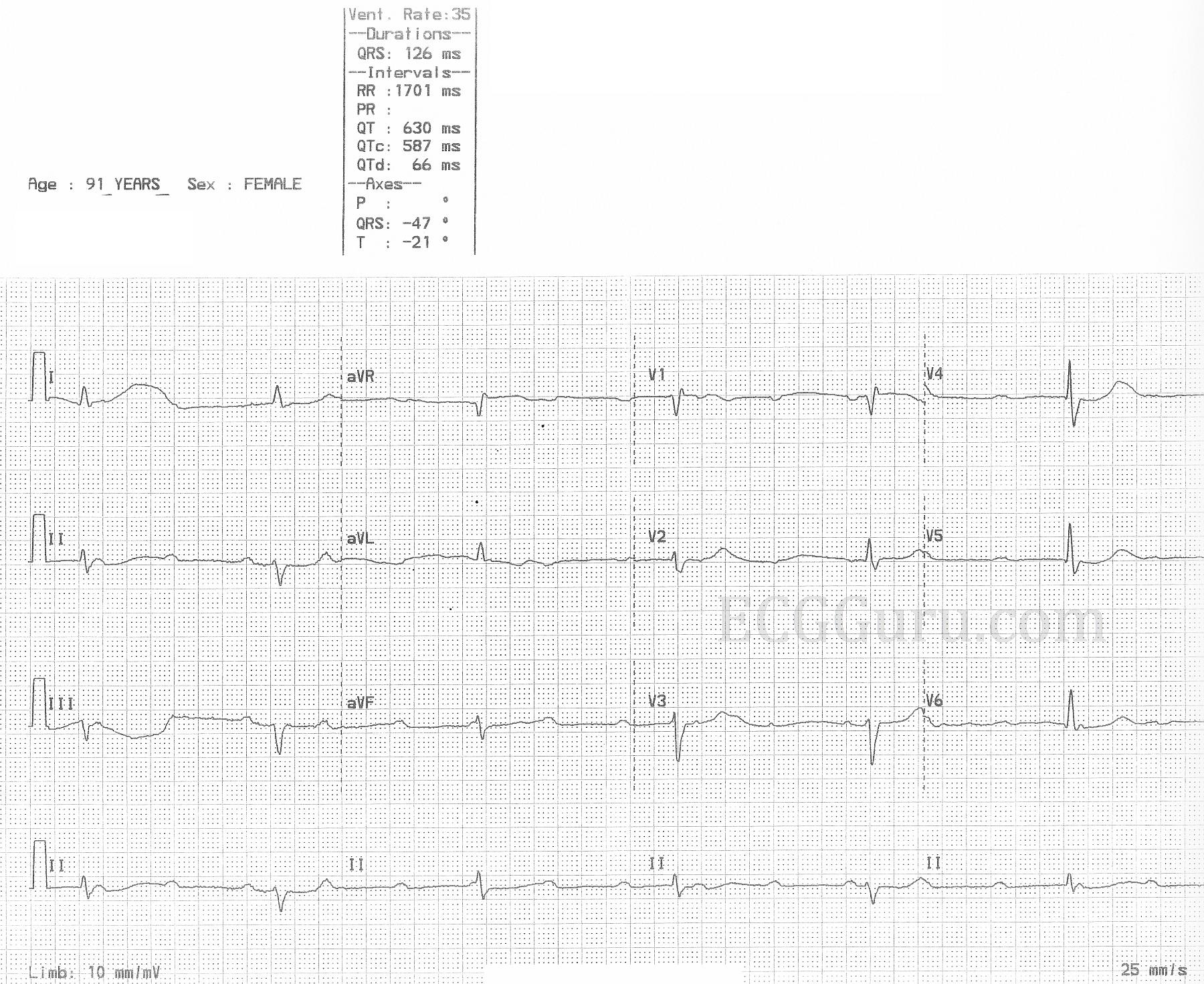 Instructors collection ecg of the week complete av block 59 off